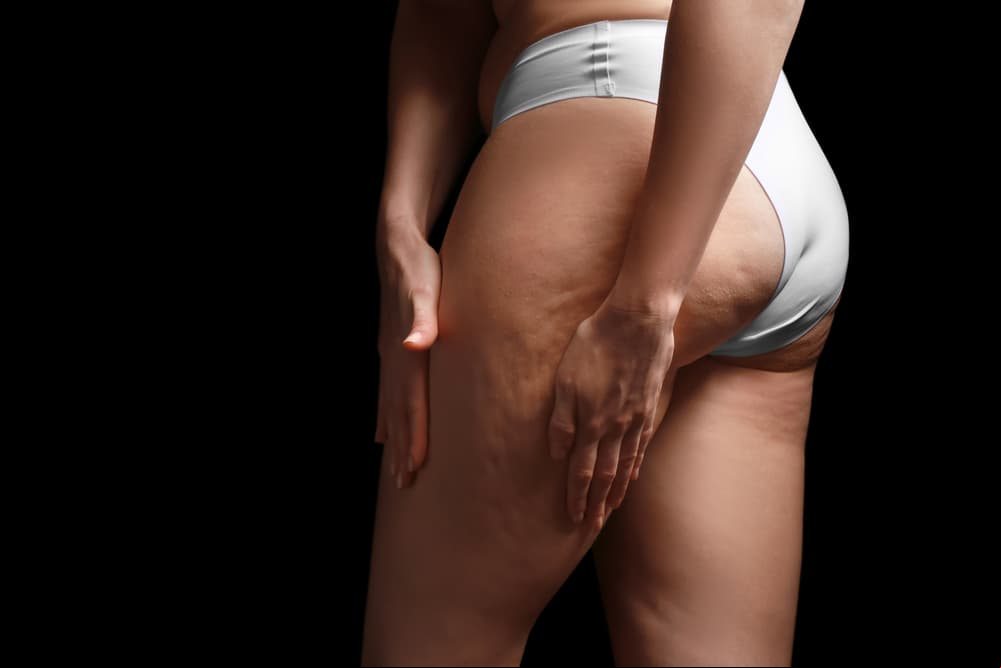 El alcohol de romero es el mejor remedio natural contra la celulitis: aprende a usarlo